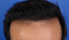 Before Hair Transplant&nbsp;Front